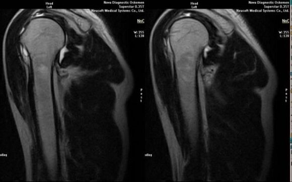 Ακτινογραφία για τη διάγνωση της αρθρώσεως του ώμου