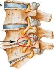 Οστεοχόνδρωση της αυχενικής μοίρας της σπονδυλικής στήλης